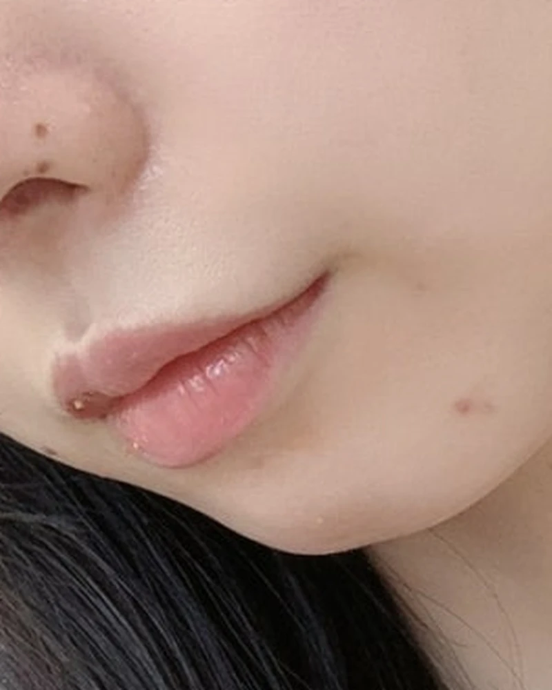 콜라겐 부스터 2 시술 후