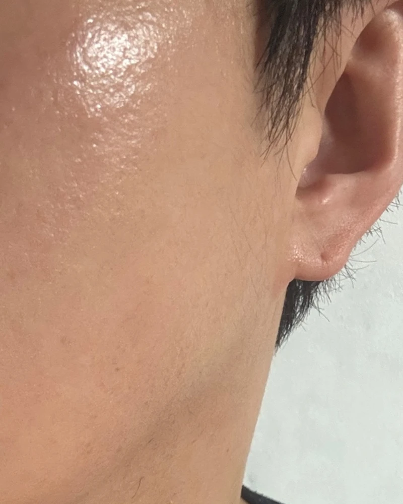 콜라겐 부스터 3 시술 후