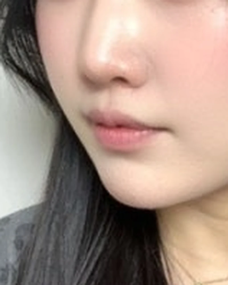 콜라겐 부스터 4 시술 후