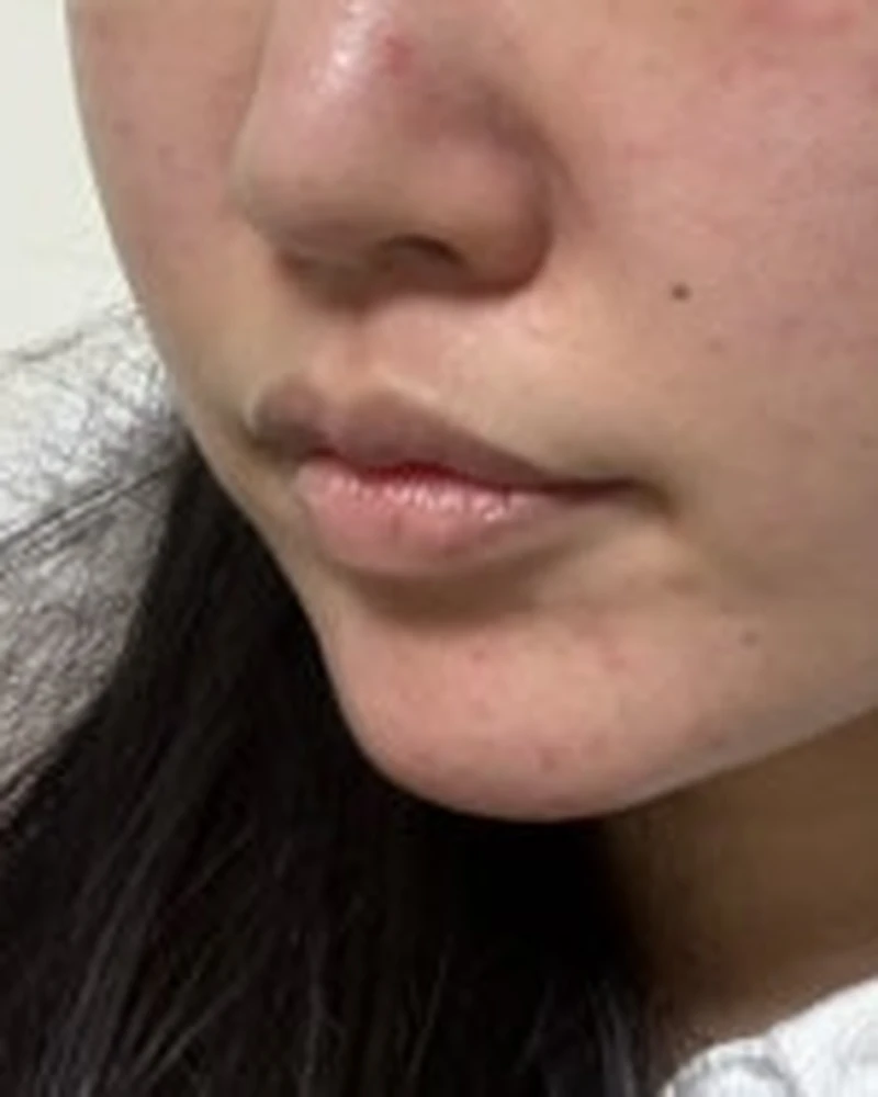 콜라겐 부스터 4 시술 전