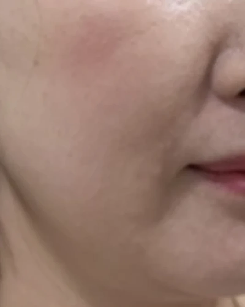 줄기세포 2 시술 전