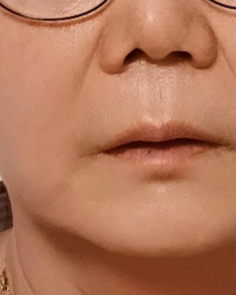 실리프팅 2 시술 후