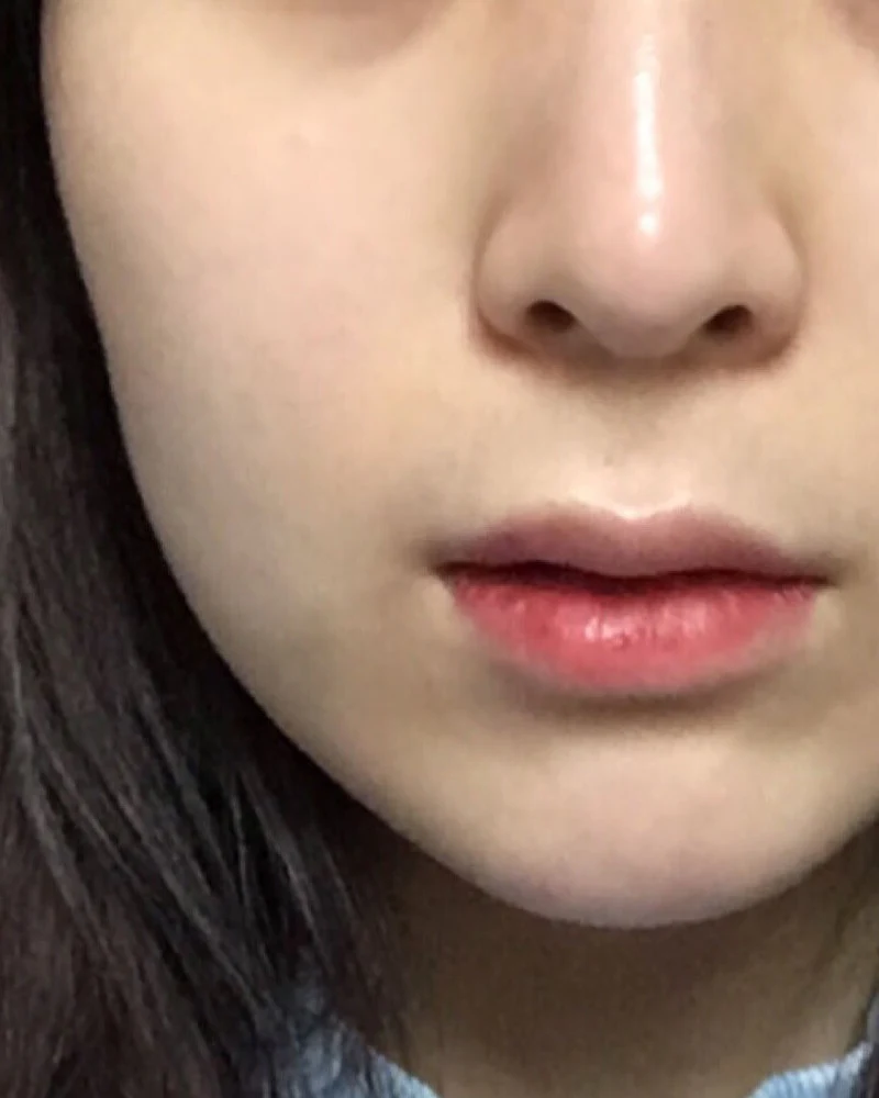 실리프팅 4 시술 전