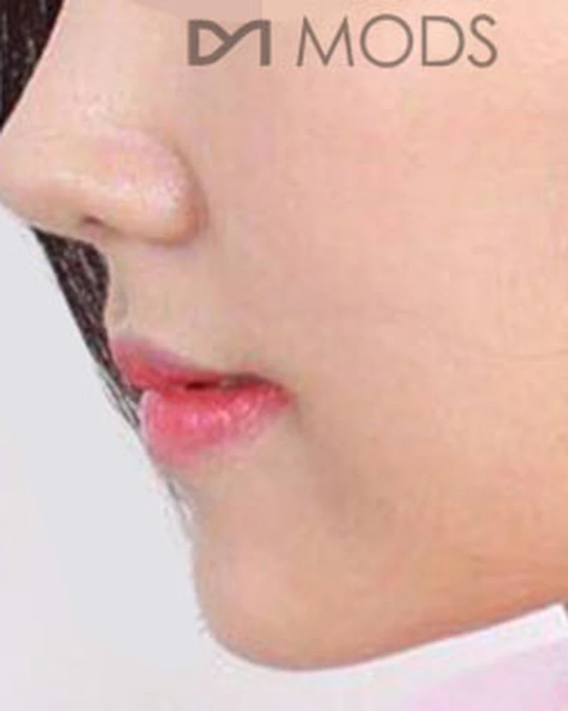 실리프팅 5 시술 후