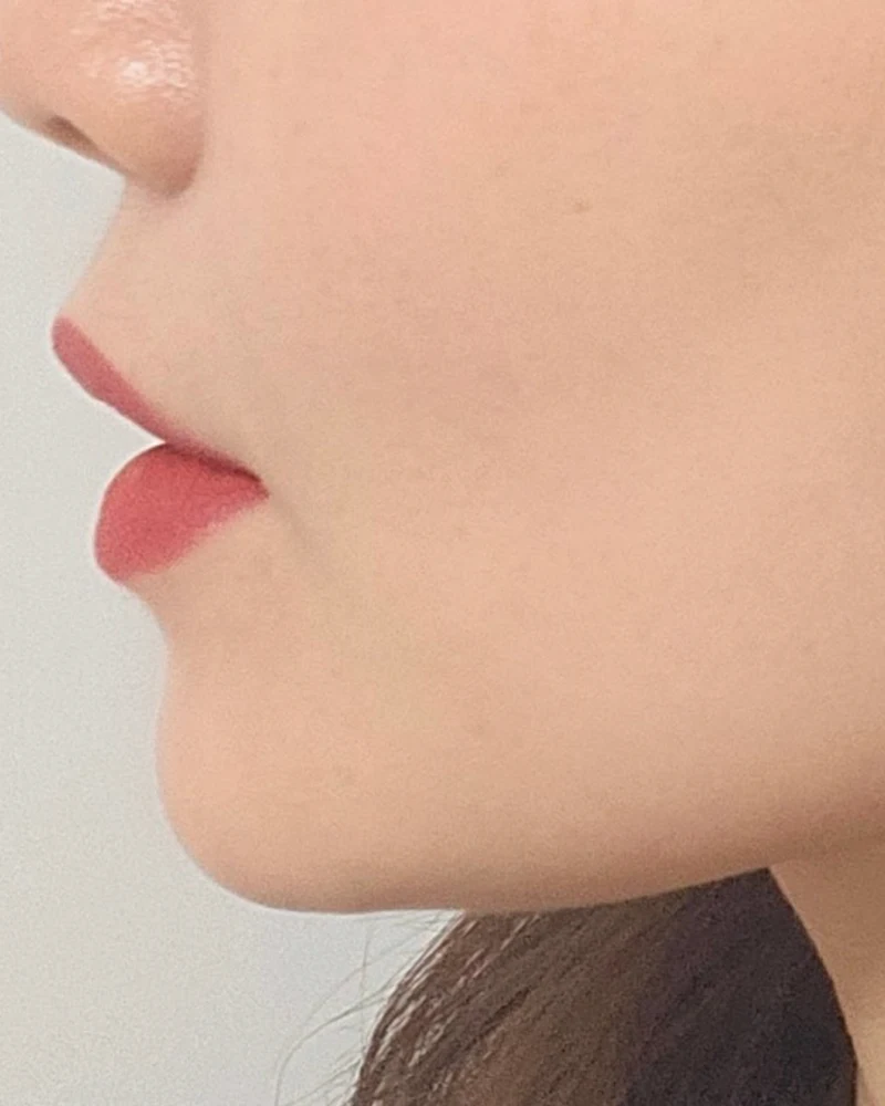 실리프팅 6 시술 후