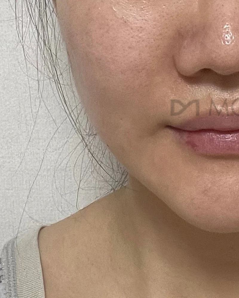 촘촘 울쎄라 4 시술 후