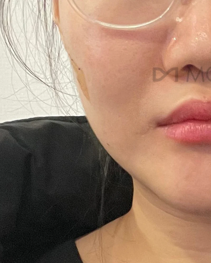 촘촘 울쎄라 4 시술 전
