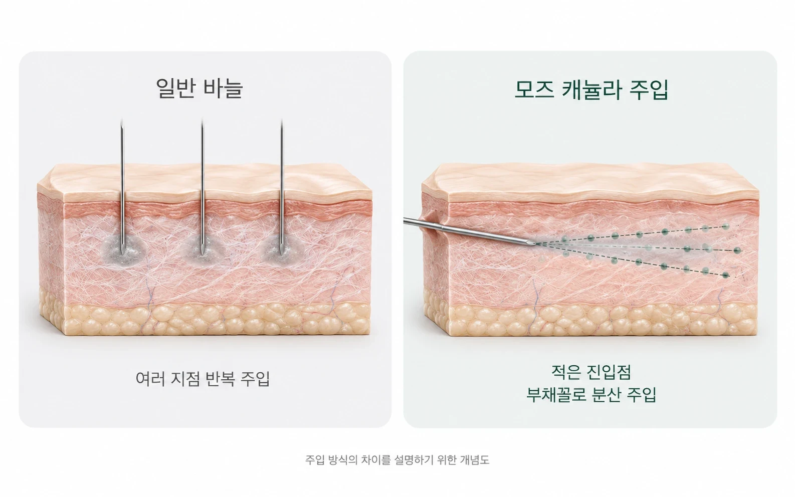 일반 바늘과 모즈 캐뉼라 주입 비교 — 일반 바늘은 여러 지점 반복 주입, 캐뉼라는 적은 진입점에서 부채꼴로 분산 주입